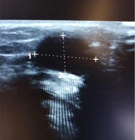 Figura 2. Ecografía: cervical anterior en la línea media formación anecoica, bien delimitada, con refuerzo posterior