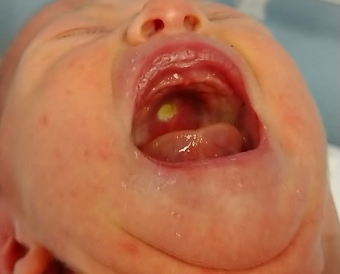 Figura 1. Úlcera de Bednar en paladar superior