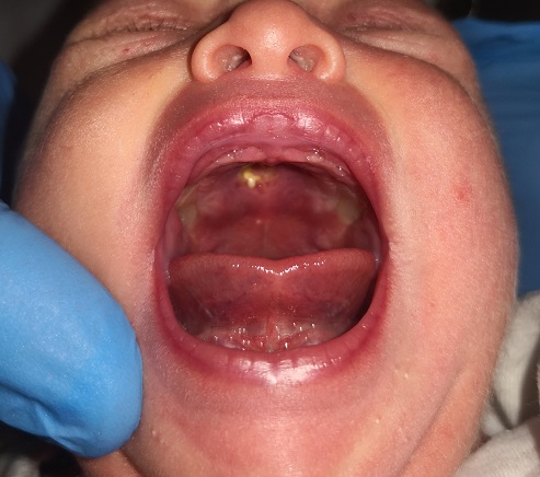 Figura 2. La herida evolucionó favorablemente sin tratamiento