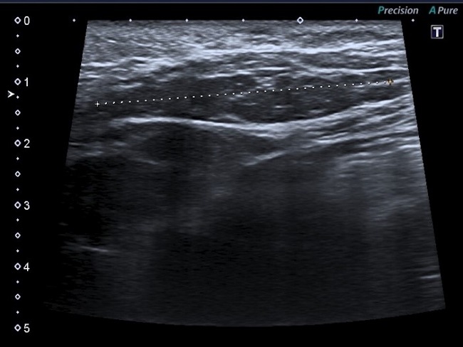 Figura 1. Ecografía de la zona lumbar derecha a los 12 meses