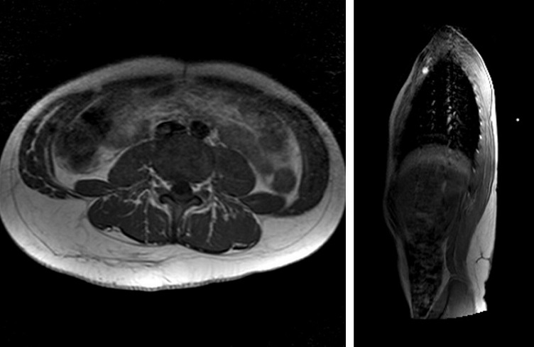 Figura 2. Imágenes de resonancia magnética a los 9 años