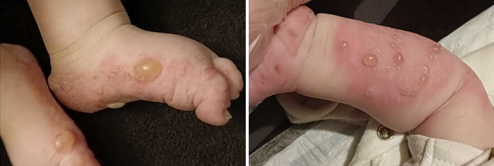Figuras 1 y 2. Lesiones ampollosas en regiones acrales con afectación de palmas y plantas