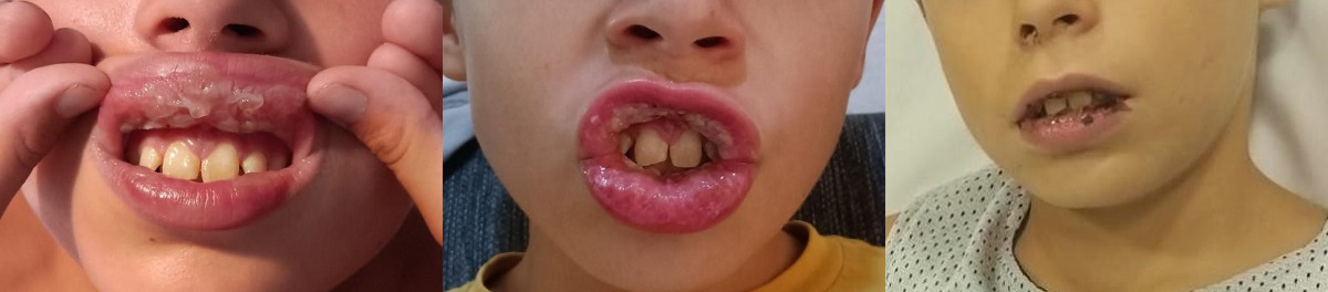 Figuras 1, 2 y 3. Lesiones ampollosas que se rompen con facilidad y evolucionan a úlceras muy dolorosas y hemorrágicas