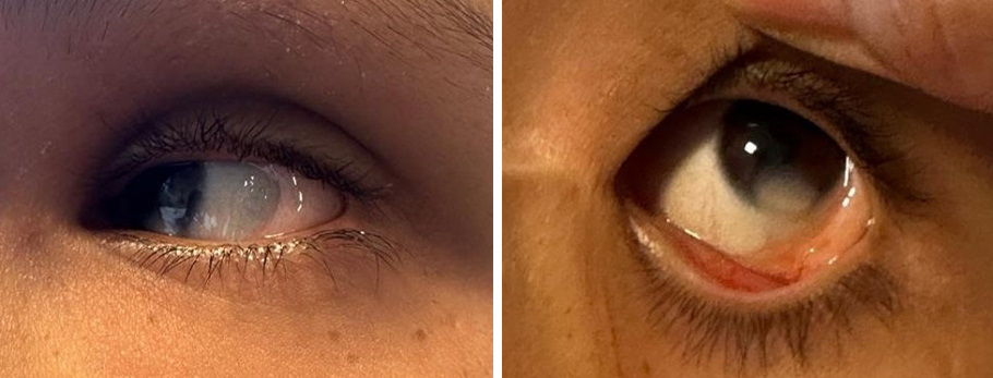 Figuras 1 y 2. Lesión ocular en zona temporal de ojo izquierdo