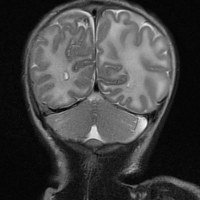 Figura 1. Colección extraxial hemitentorial derecha de 4 mm de espesor compatible con hematoma subdural