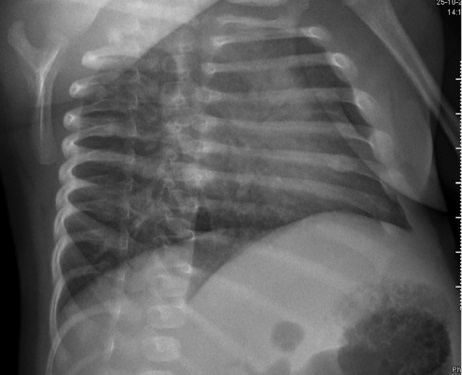 Figura 2. Callo de fractura en el borde lateral del 6º arco costal izquierdo