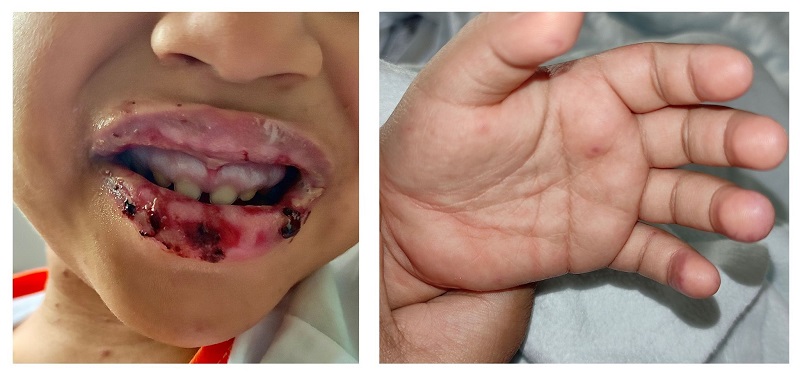 Figura 1. Labios edematosos y friables con costras. Lesiones papulares en la palma de la mano