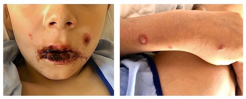 Figura 2. Labios edematosos y con costras friables. Lesiones eritemato-vesiculosas en el antebrazo