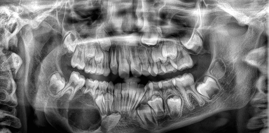Figura 3. Ortopantomografía