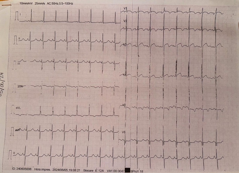 Figura 1. Electrocardiograma del centro de salud con signos de HVI