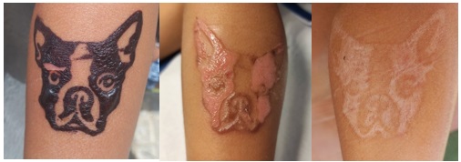 Figura 1. Evolución del tatuaje con henna negra. 