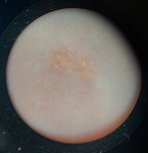 Figura 1. Imagen de la lesión en el dermatoscopio. 