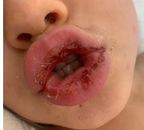 Figura 1. Descamación con lesiones costrosas sobre la superficie de la mucosa labial.