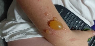 Figura 1. Lesiones ampollosas en antebrazo derecho