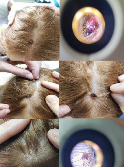 Figura 1. Desarrollo de la lesión y evolución del caso.