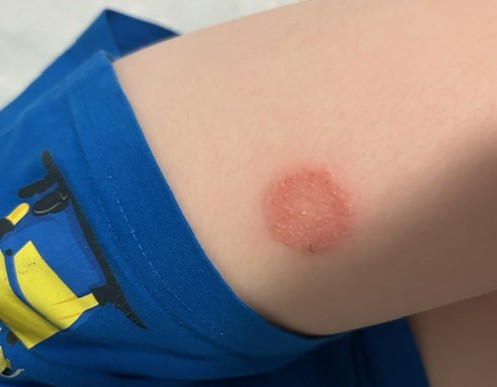 Figura 1. Lesión después de una picadura