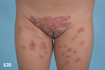 Figura 1. Lesiones costrosas