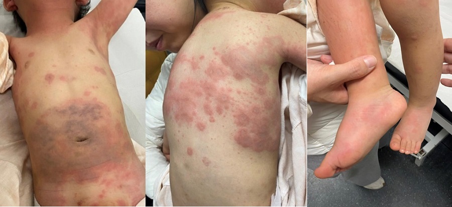 Figura 1. Lesiones habonosas anulares, algunas con centro violáceo, y edema de pies.