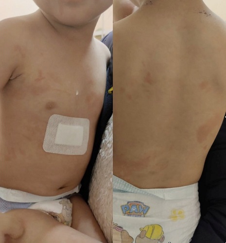 Figura 2. Evolución de las lesiones tras 5 días.