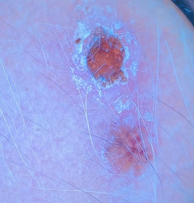 Figura 1. Nevus de Meyerson