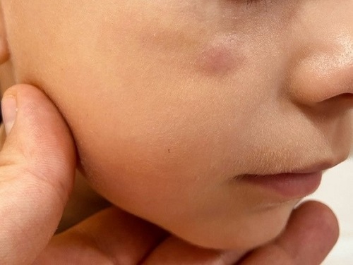 Figura 1. Granuloma aséptico facial idiopático