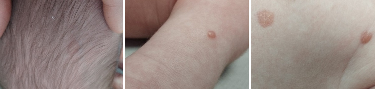 Figura 1. nódulos cutáneos sobreelevados en las regiones axilares bilaterales, en el cuero cabelludo y en el brazo