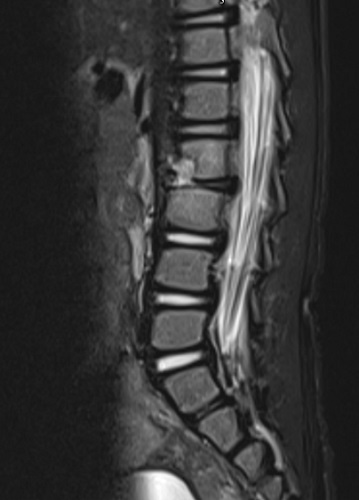 Figura 1. Espondilodiscitis L2-L3 con absceso prevertebral y en psoas derecho
