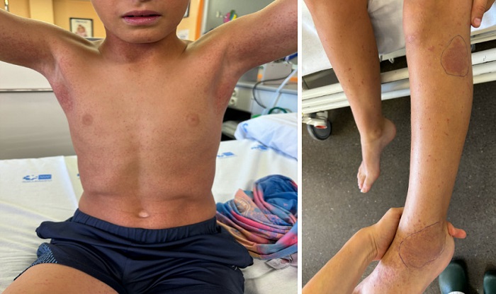 Figura 1. Exantema petequial por parvovirus B19