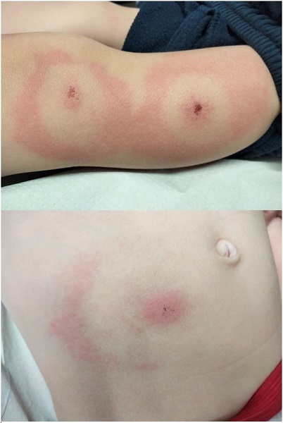 Figura 1. Lesiones cutáneas, con costra central, halo eritematoso y centro claro