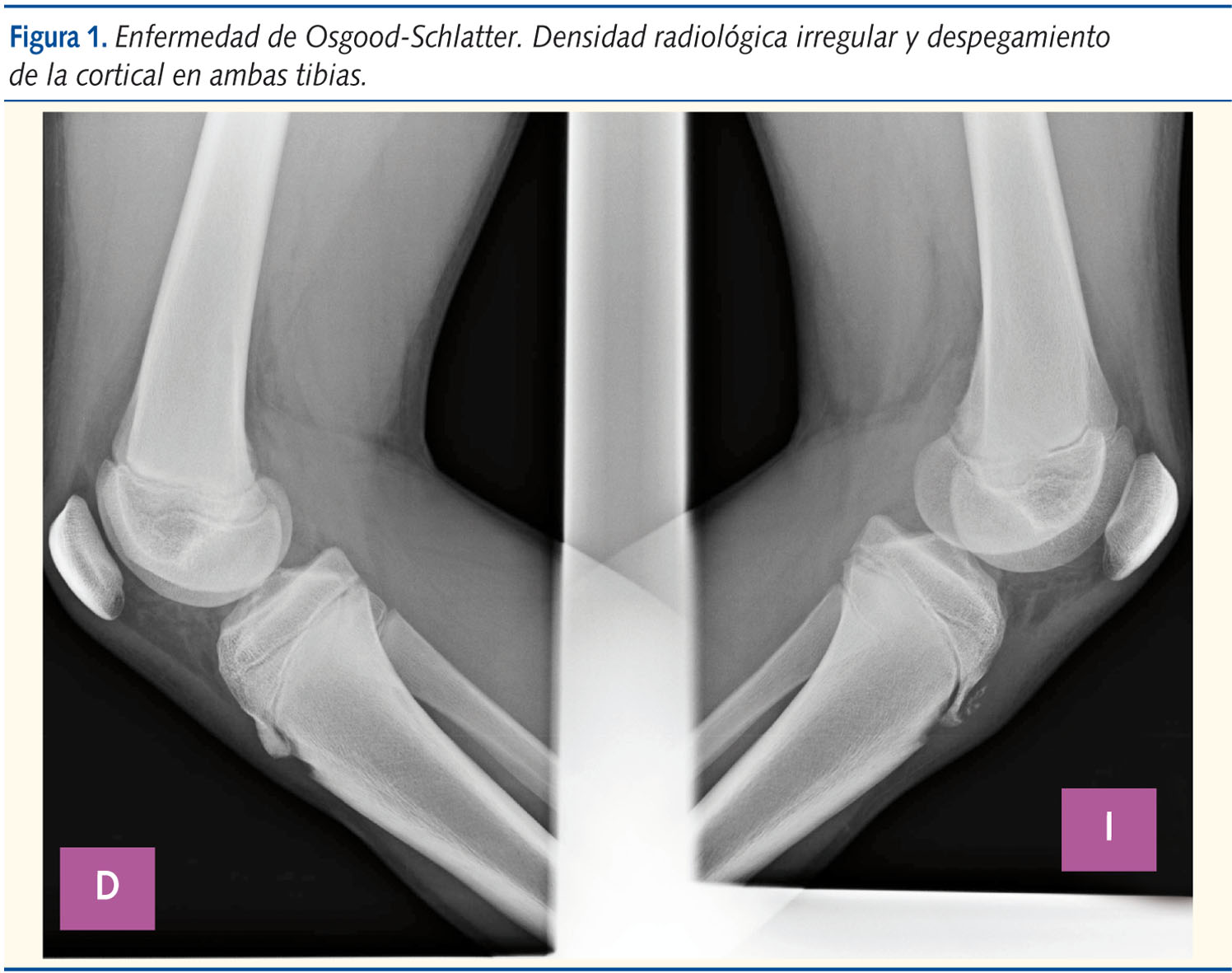 Figura 1. Enfermedad de Osgood-Schlatter. Densidad radiológica irregular y despegamiento de la cortical en ambas tibias.