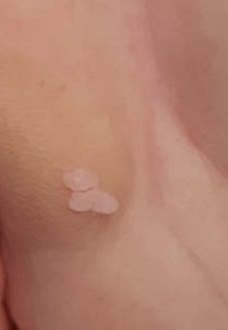 Figura 1. Lesión verruciforme blanquinosa en labio mayor izquierdo vulvar