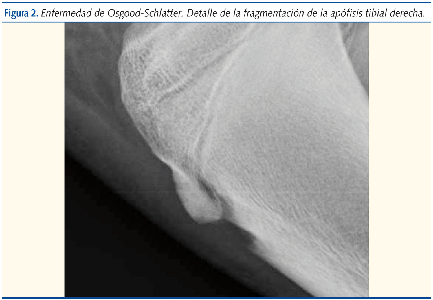 Figura 2. Enfermedad de Osgood-Schlatter. Detalle de la fragmentación de la apófisis tibial derecha.