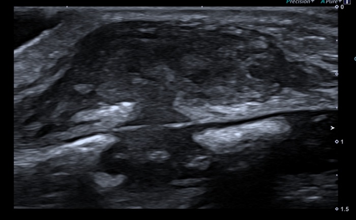 Figura 1. Ecografía de partes blandas donde se objetiva imagen típica en “reloj de arena” de los SELSTOC