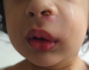 Figura 1. Absceso malar y nasal izquierdo con salida de contenido purulento