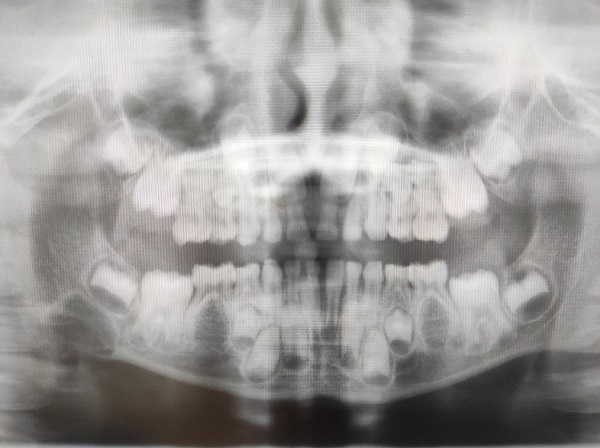Figura 1. Lesión redondeada radiolúcida de aproximadamente 12 x 5 mm