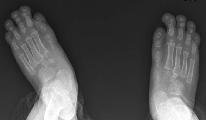 Figura 1. Pies aductos con sindactilia y acortamiento de falanges en primer dedo de ambos pies