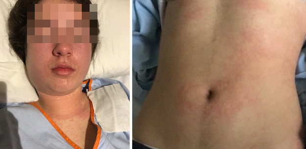 Figura 1. Aspecto de la tumefacción mandibular derecha y del exantema de tipo maculopapular de predominio en tronco