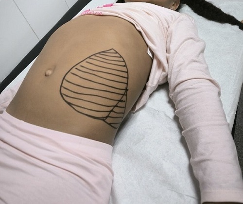 Figura 1. Esplenomegalia