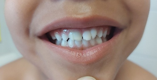 Figura 2. Incisivos centrales superiores fusionados