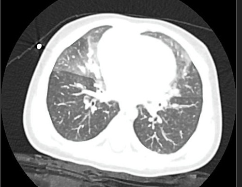 Figura 1. TAC con hallazgos de HNE en ambos pulmones.