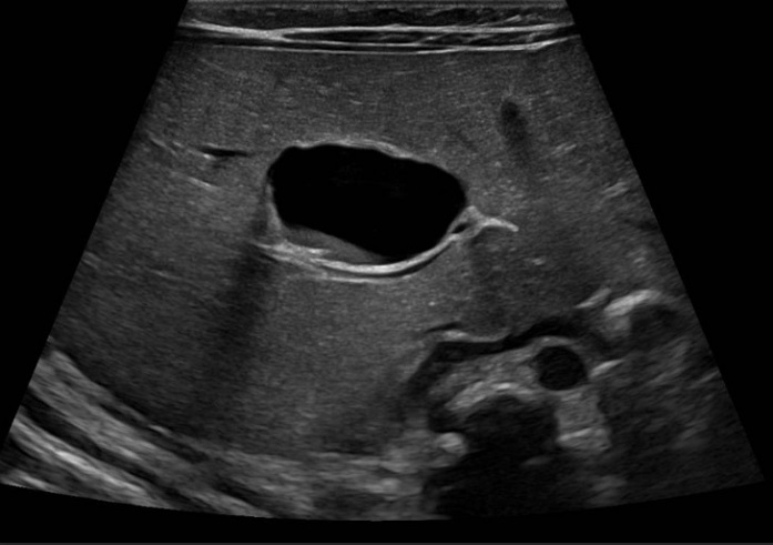 Figura 3. Quiste hepático congénito. Ecografía posnatal de control. En el segmento IV continúa visualizándose un quiste simple unilocular de pared fina, de diámetros similares al estudio previo (25 x 17 mm en sus ejes TR x AP), actualmente con un pequeño nivel ecogénico declive en su interior