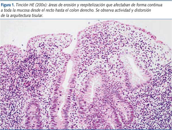 Figura 1. Tinción HE (200x): áreas de erosión y reepitelización que afectaban de forma continua a toda la mucosa desde el recto hasta el colon derecho. Se observa actividad y distorsión de la arquitectura tisular.