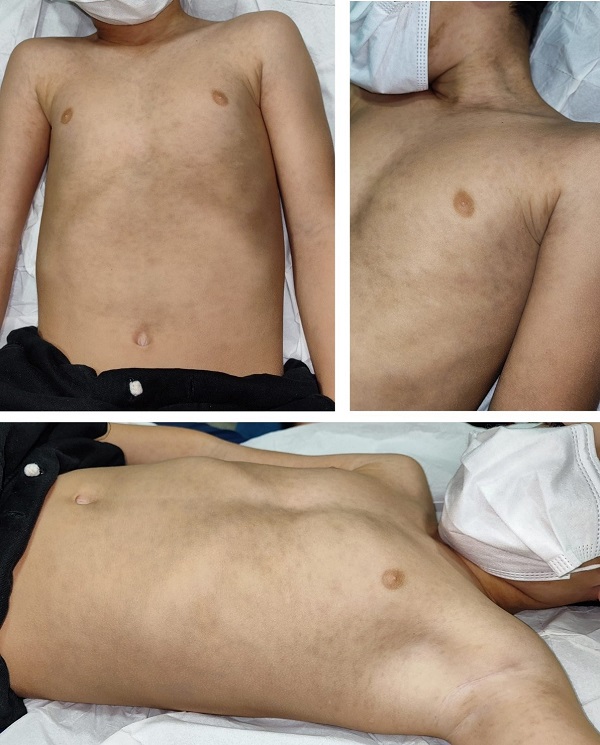 Figura 1. Máculas hiperpigmentadas de entre 2-7 mm en nuca, tronco y miembros superiores