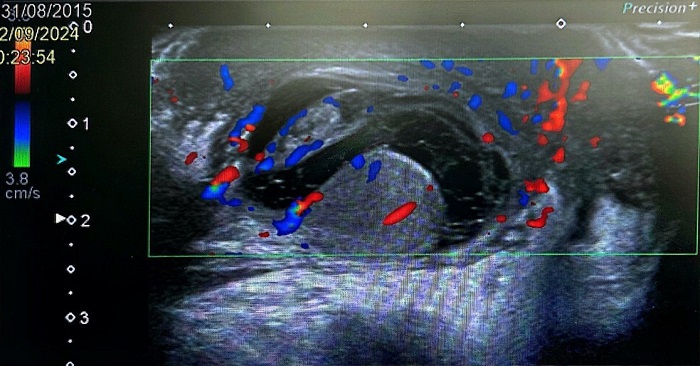 Figura 1. Ecografía testicular del paciente, que muestra una colección tabicada compatible con piocele