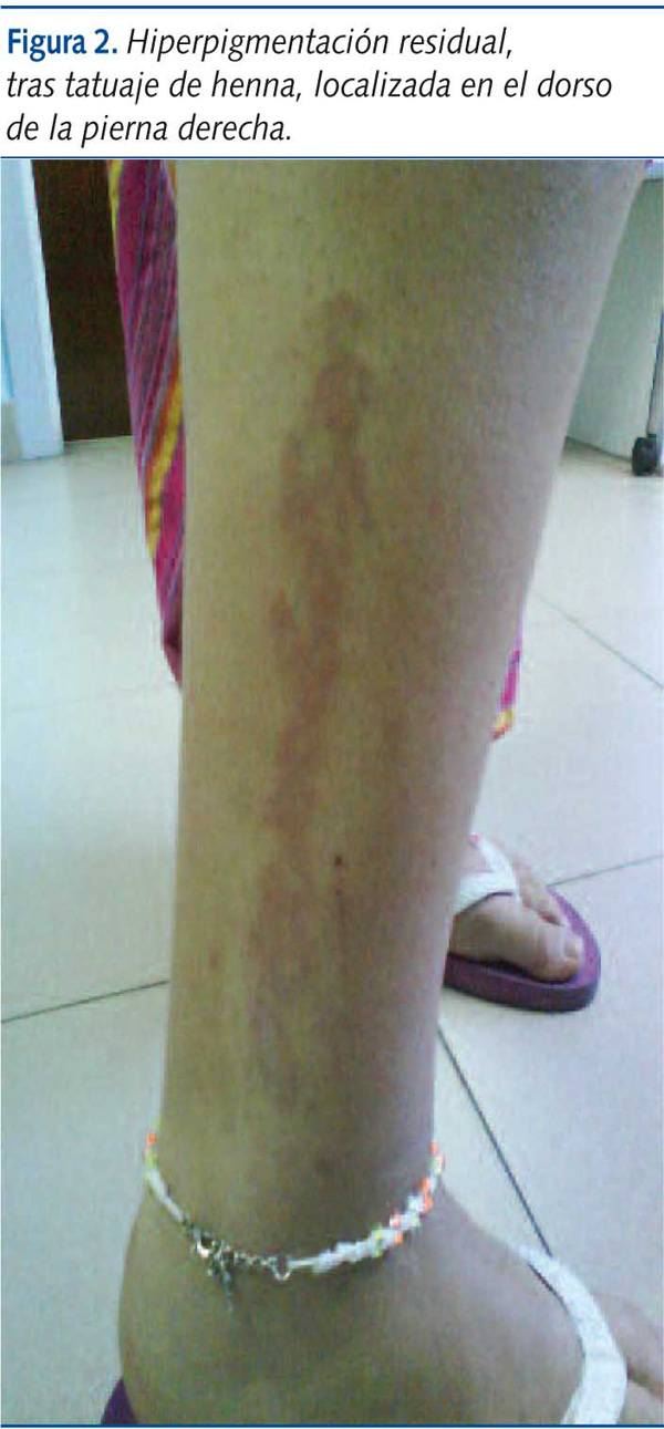 Figura 2. Hiperpigmentación residual, tras tatuaje de henna, localizada en el dorso de la pierna derecha.