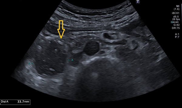 Figura 1. En esta ecografía abdominal se visualiza la notable dilatación de la segunda porción duodenal, durante la fase clínica del paciente