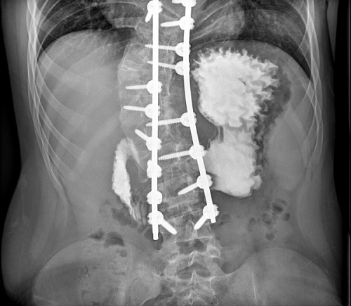 Figura 2. Tránsito digestivo superior. Opacificación rápida del duodeno hasta su tercera porción, sin dilatación