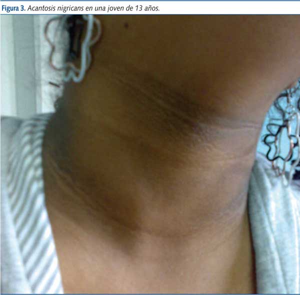 Figura 3. Acantosis nigricans en una joven de 13 años.