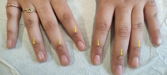 Figura 1. Manos de adolescente de 13 años. Nódulos subcutáneos sobre dorso de articulaciones interfalángicas distales (flechas amarillas)
