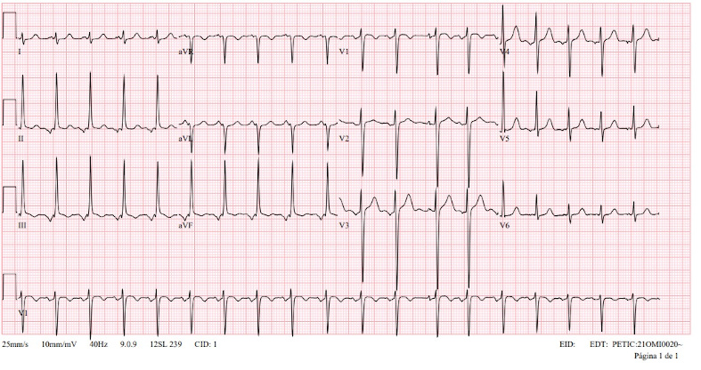 Figura 1. Ritmo sinusal. Electrocardiograma con taquicardia auricular ectópica (onda P negativa en aVF) 